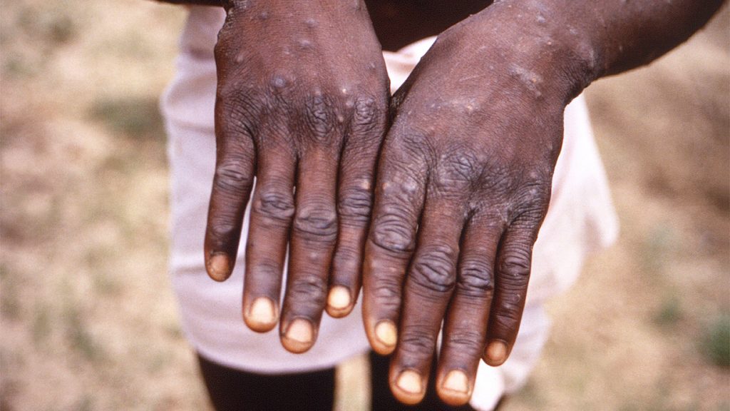 Monkeypox: Another Lesson in Global Health Neglect