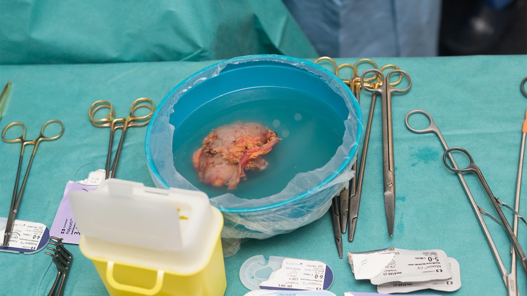 The Kidney Transplant Ecosystem Is Ripe for Reform