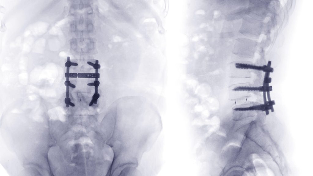 Spinal Surgery Redux: Advancing Our Approach to Back Pain