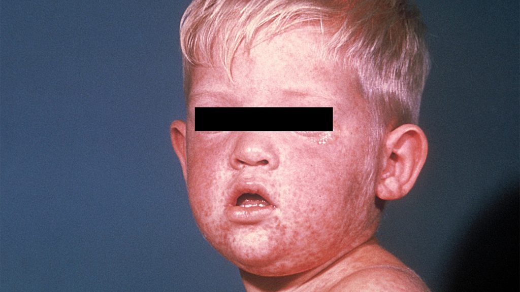 Measles’ Deadliest Sequelae