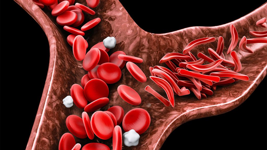 Too Many Kids With Sickle Cell Disease Aren’t Getting Appropriate Preventive Care