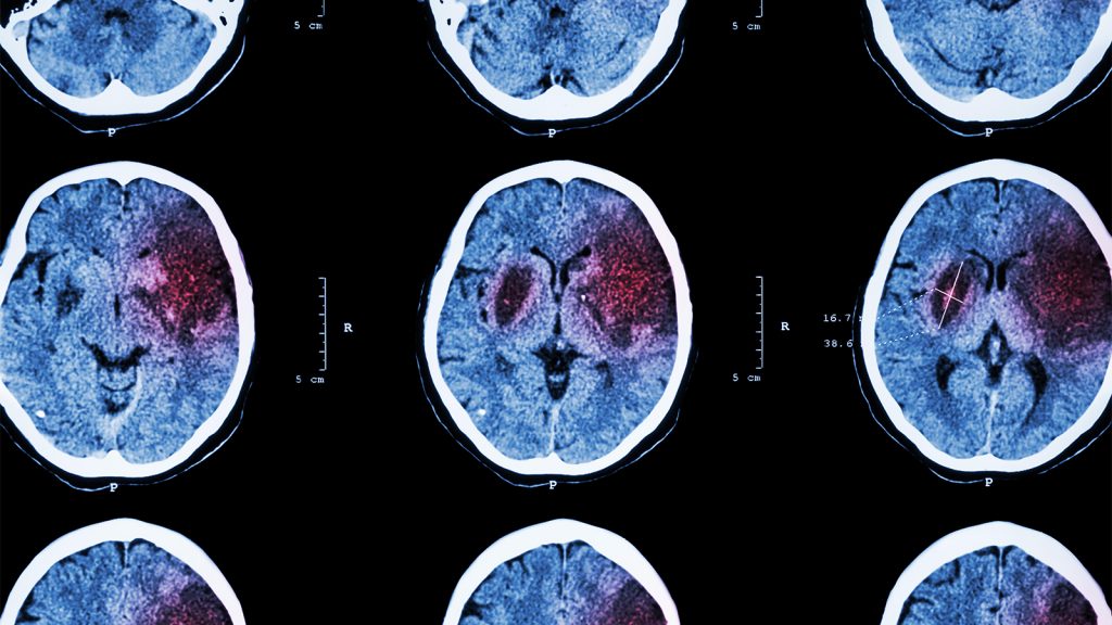 Stroke Risk Is Changing With the Climate
