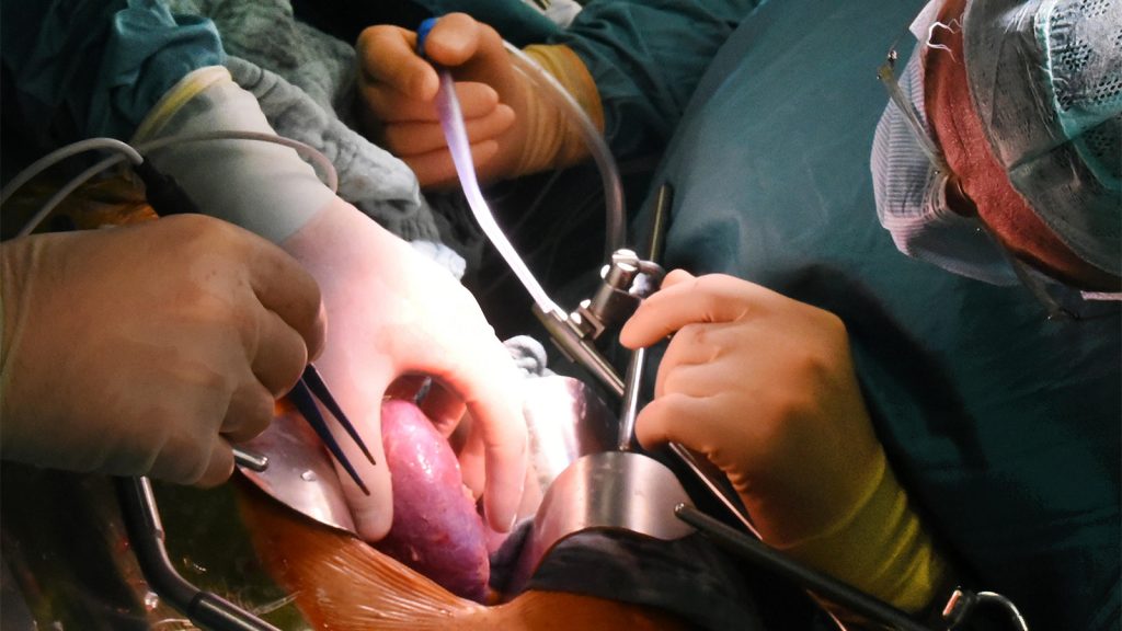 Here’s What It Will Take to Grow HIV-Positive to HIV-Positive Transplant Access