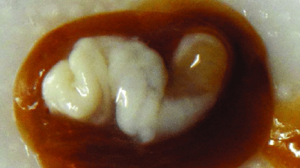 The Naked Truth About the World’s Most Common ‘Brain Worm’